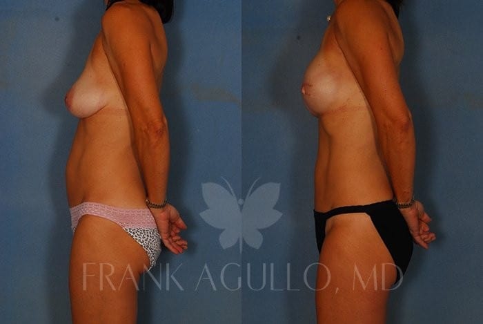 Breast Reconstruction Before and After 5