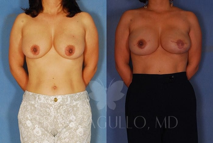 Breast Before and After 15