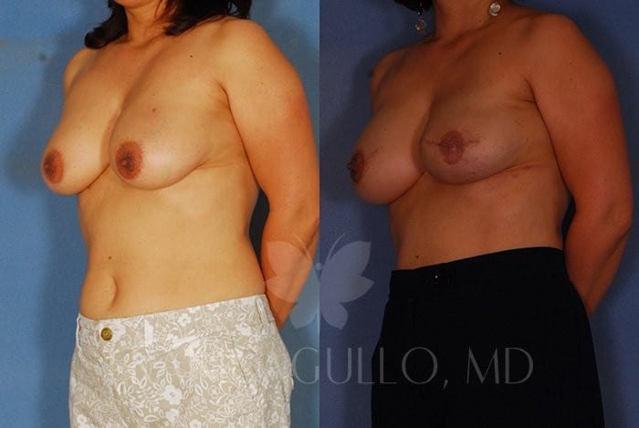 Breast Reconstruction Before and After 2