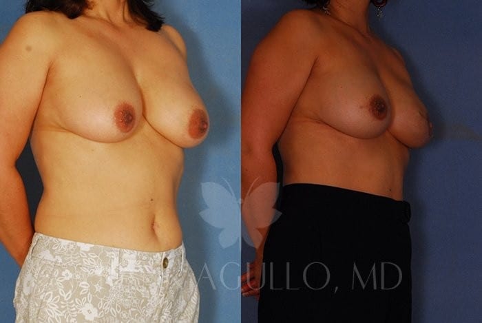 Breast Reconstruction Before and After 3