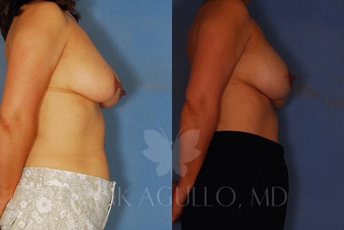 Breast Reconstruction Before and After 4