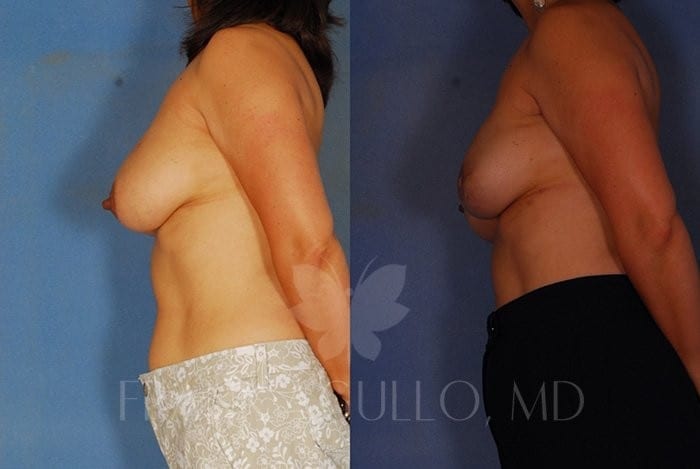 Breast Reconstruction Before and After 5