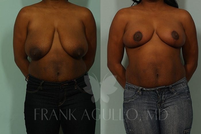 Breast Reduction Before and After 10