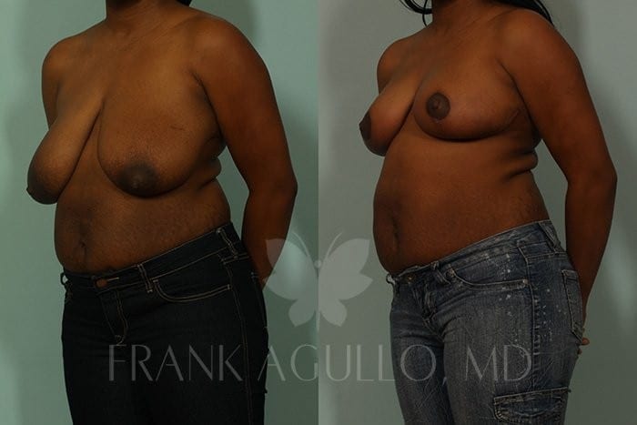 Breast Reduction Before and After 2