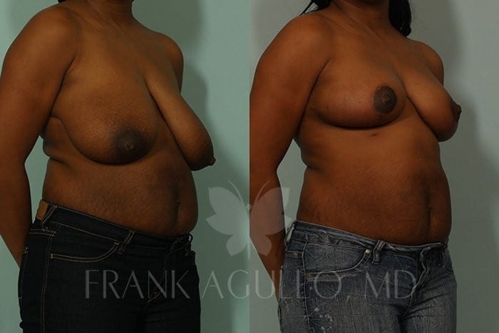 Breast Reduction Before and After 3