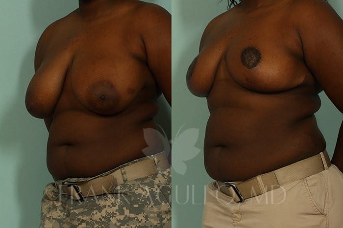 Breast Reduction Before and After 6