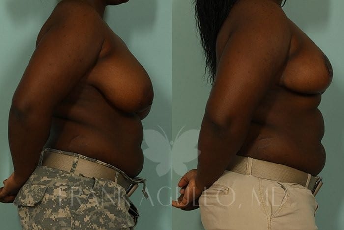 Breast Reduction Before and After 8