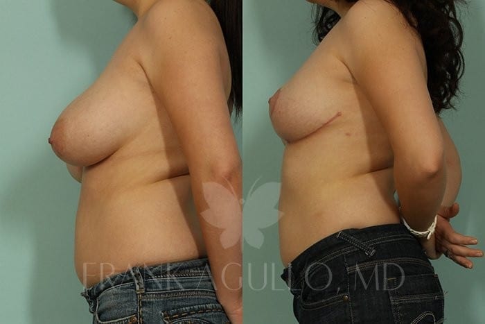 Breast Reduction Before and After 4