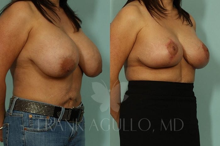 Breast Reduction Before and After 8