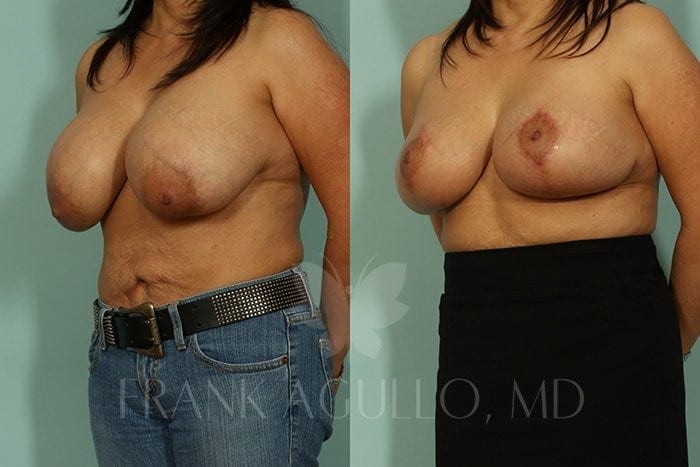 Breast Reduction Before and After 2