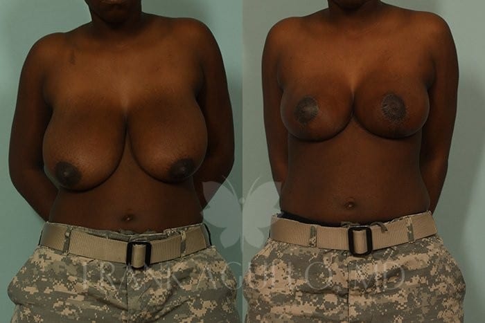 Breast Reduction Before and After 7