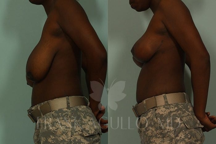 Breast Reduction Before and After 3