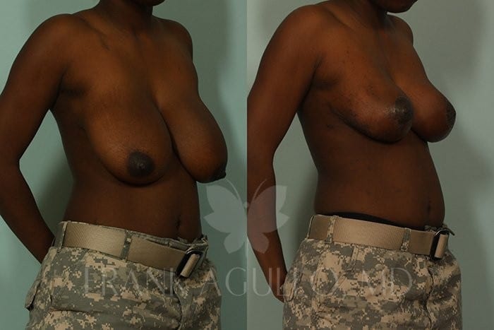 Breast Reduction Before and After 4