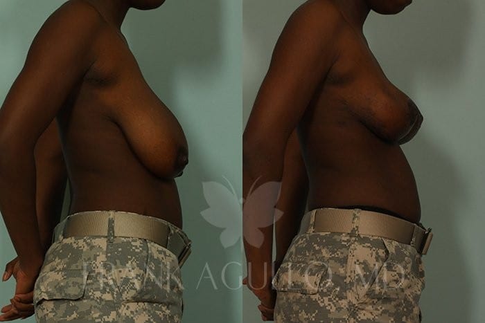 Breast Reduction Before and After 5