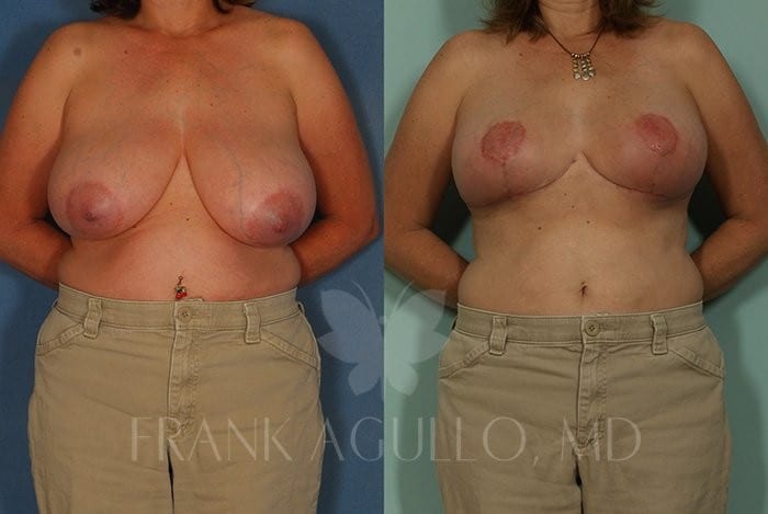 Breast Reduction Before and After 6