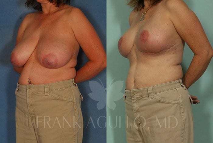 Breast Reduction Before and After 3