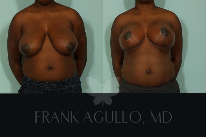 Breast Reduction Before and After 5