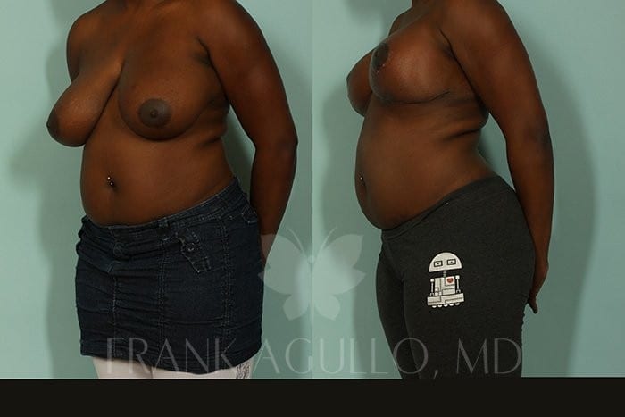 Breast Reduction Before and After 2