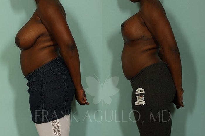 Breast Reduction Before and After 3