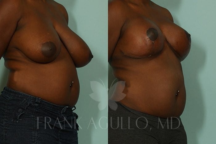 Breast Reduction Before and After 4