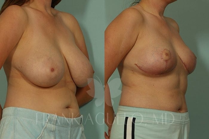 Breast Reduction Before and After 4