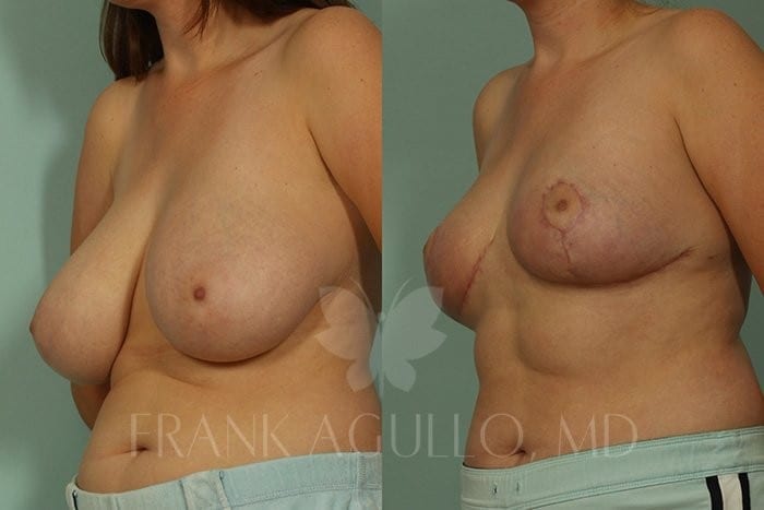 Breast Reduction Before and After 2