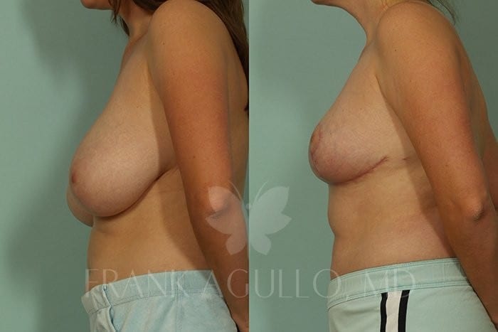 Breast Reduction Before and After 3