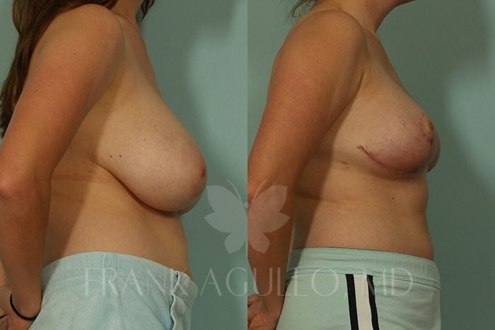 Breast Reduction Before and After 4