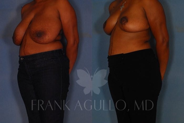 Breast Reduction Before and After 3