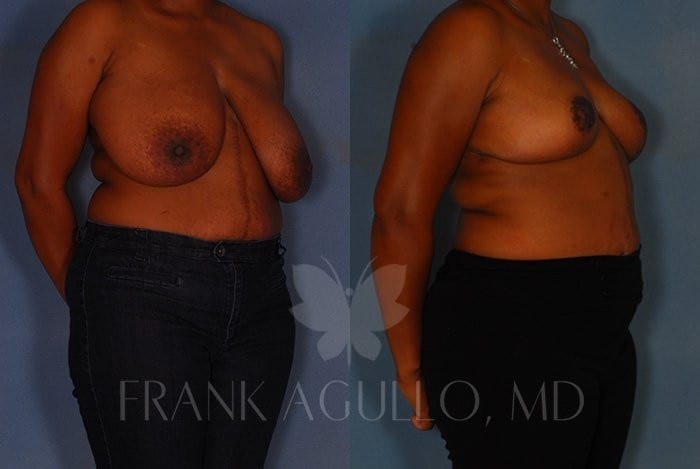 Breast Reduction Before and After 2