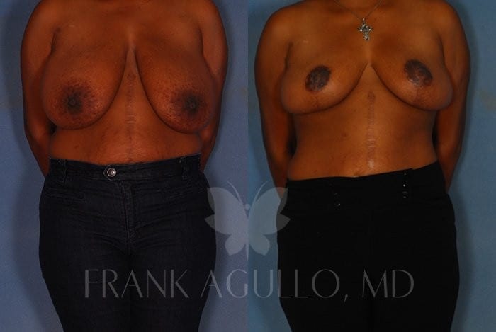 Breast Reduction Before and After 3
