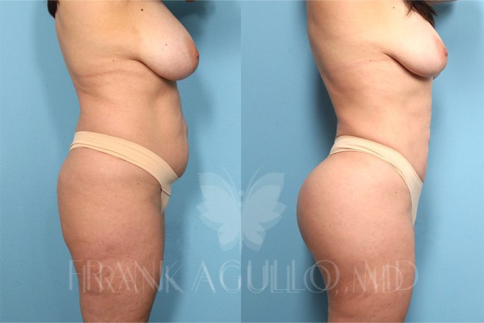Butt Implants Before and After 1