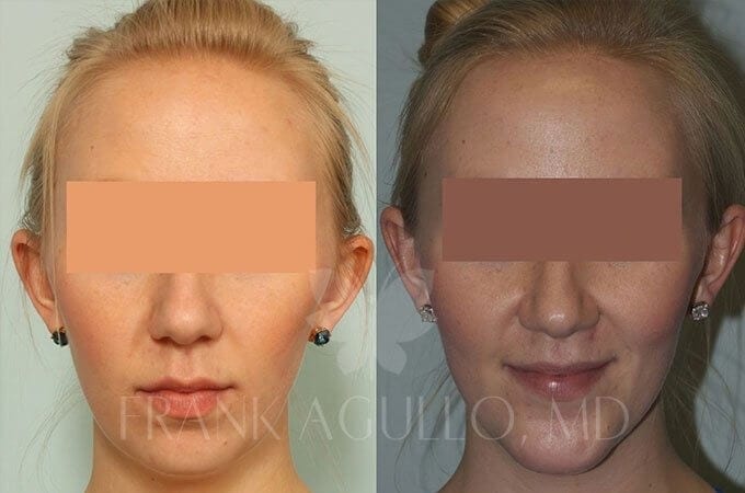 Chin Implant Before and After 2