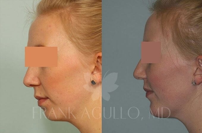 Chin Implant Before and After 2