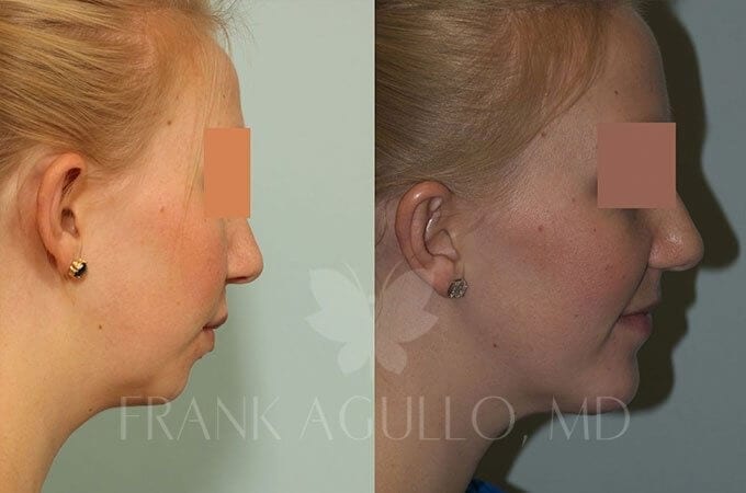 Chin Implant Before and After 3