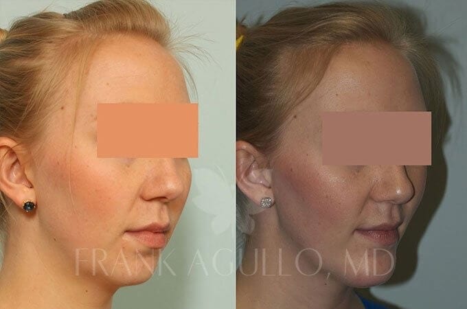 Chin Implant Before and After 4