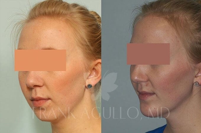 Chin Implant Before and After 5