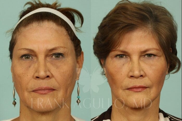 Face Lift Before and After 3