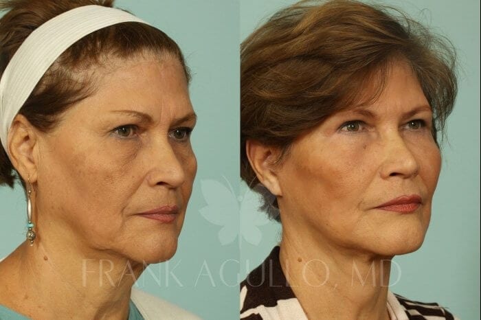 Face Lift Before and After 2
