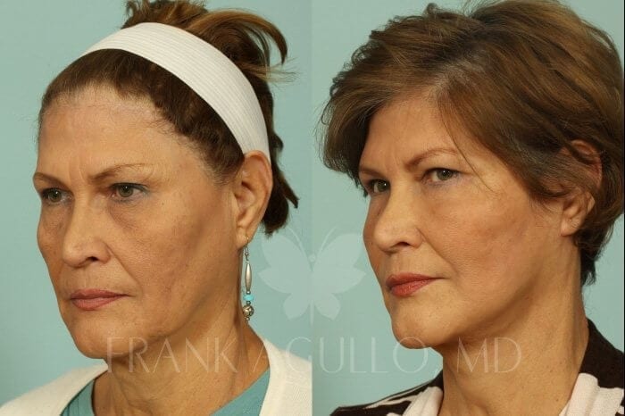 Face Lift Before and After 4
