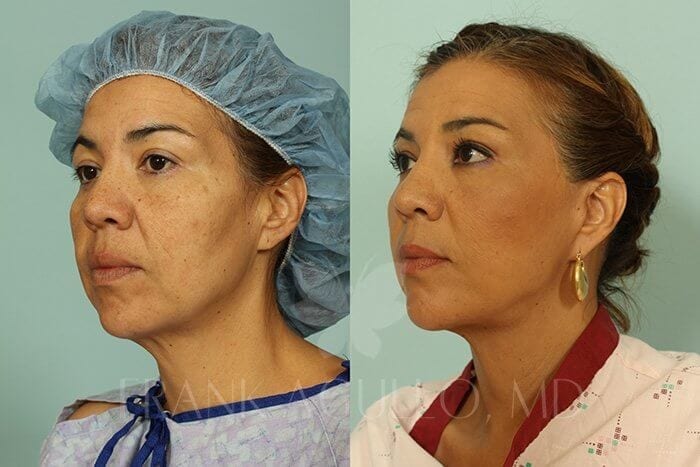 Face Lift Before and After 2