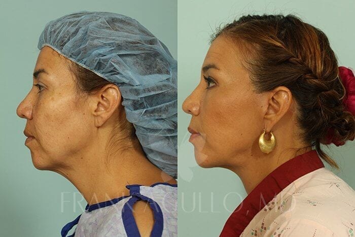 Face Lift Before and After 3