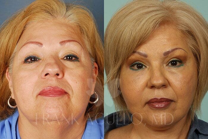 Face Lift Before and After 1