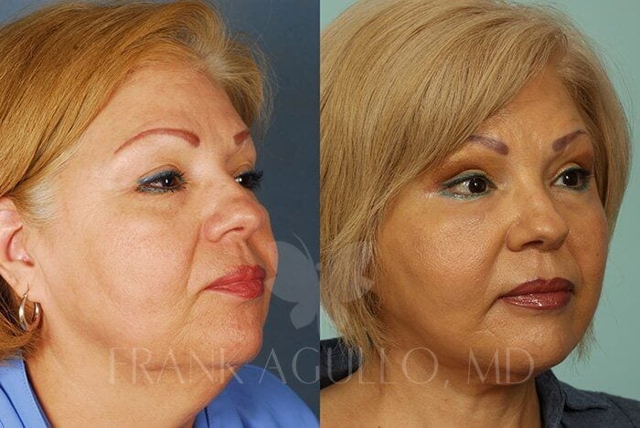 Face Lift Before and After 2