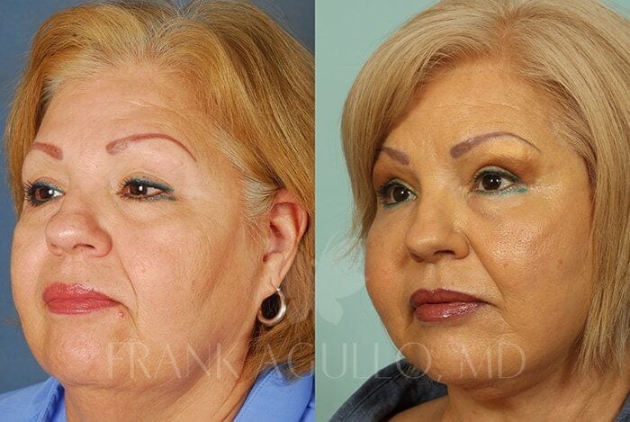 Face Lift Before and After 3