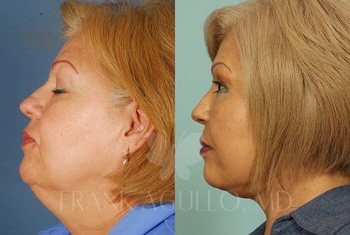 Face Lift Before and After 4