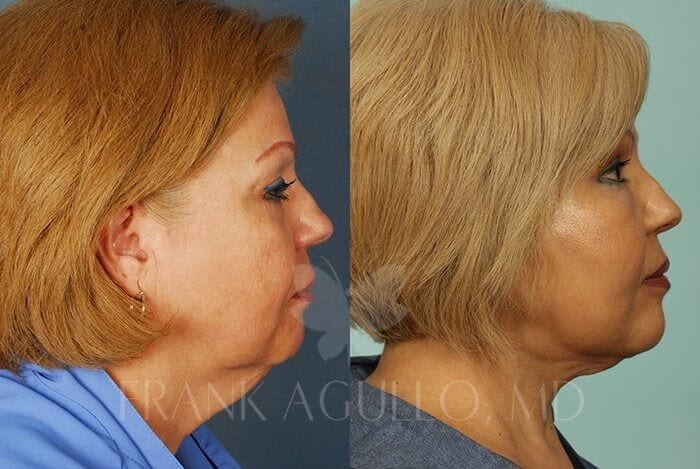 Face Lift Before and After 5