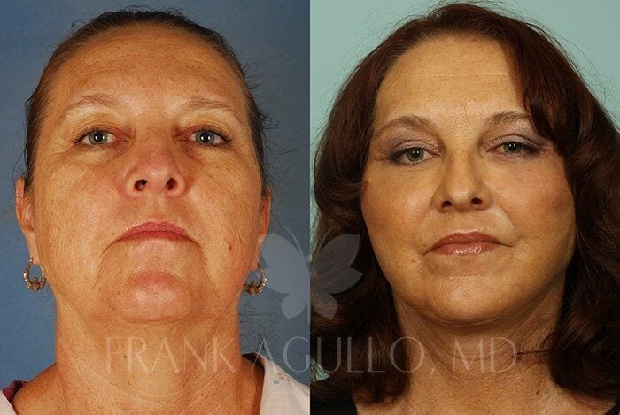 Face Lift Before and After 20