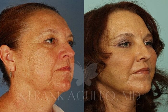 Face Lift Before and After 2