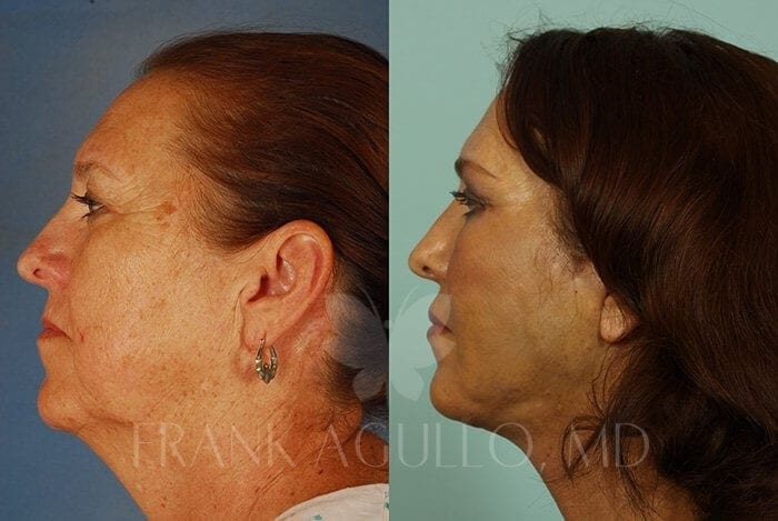 Face Lift Before and After 3